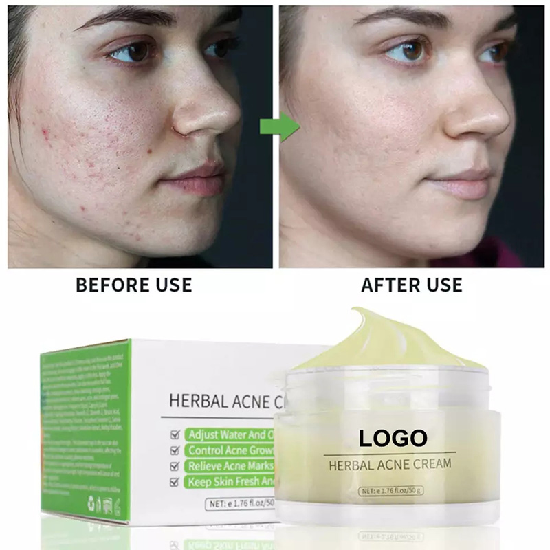 Private Label Best Natural Organic Plant Extract Anti Pimples Remover Acne Treatment Cream
