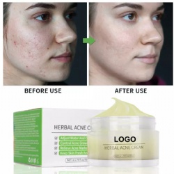 Private Label Best Natural Organic Plant Extract Anti Pimples Remover Acne Treatment Cream
